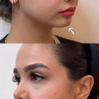 کانتورینگ صورت با فیلر.زاویه سازی،فرم‌دهی،حجم دهی