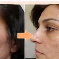 رفع لک پوست با کرم بیوممتیک تحویل یک روزه