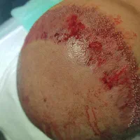 کاشت مو با خط رویش طبیعی و تراکم عالی