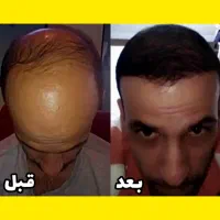 رشد مجدد مو در یک ماه