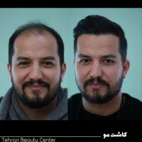 کاشت مو / کاشت ابرو / بلفارو /رفع غبغب