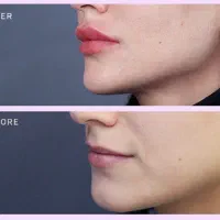 ژل بوتاکس لیفت بانخ مزو prp