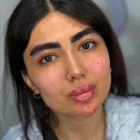 کیلینیک تخصصی ژل و‌بوتاکس مزو فیلر بادی باسن