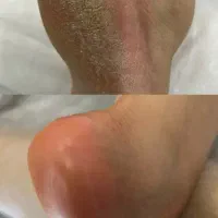 تخلیه میخچه و کفسابی