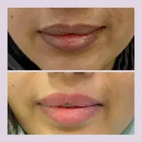 فیلرلب|خدمات آرایشگری و زیبایی|زاهدان, |دیوار