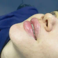 تخفیف خدمات ژل فیلر بوتاکس