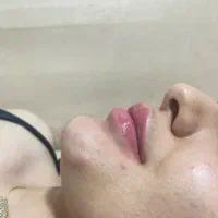 ژل و بوتاکس