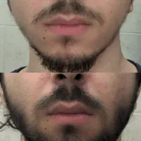 ریشاتو ۲۰ روزه پرپشت کن