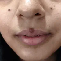خدمات خال برداری،میخچه ،زگیل بامحلول بصورت سرپایی