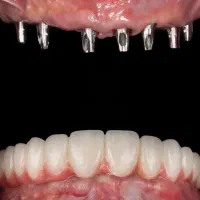 دندانپزشکی تخصصی/ ایمپلنت/ روکش ایمپلنت/ لمینت