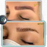 پاک کردن تتو ابرو ریموو خالکوبی با لیزر توسط پزشک