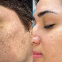 لیزر لک و جای جوش و بخیه