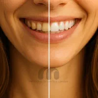 جرمگیری و بلیچینگ دندان مواد آلمانی