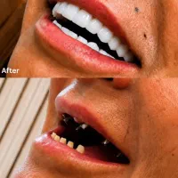 ایمپلنت دندان ، اقساطی ، شرایط ویژه ، با ضمانت