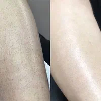 لیزر برای کسانی ک  با هر دستگاهی جواب نگرفتن