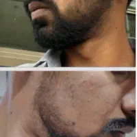بمب رویش ریش