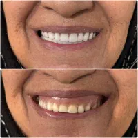 دندانسازی / دندان مصنوعی با ضمانت چندساله