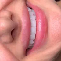 کامپوزیت زیبایی لبخند هالیوودی در ۲۴ساعت