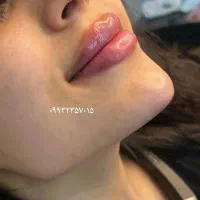 تزریق ژل و بوتاکس/فول فیس/تخفیف ۲۰٪