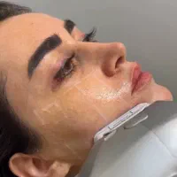 هایفوتراپی لیفت صورت - لیزر کندلا 2024