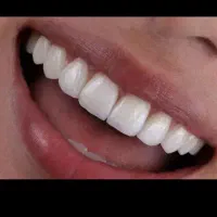 کامپوزیت،لمینیت،خدمات درمانی دندانپزشکی‌،اقساطی