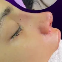 عمل بینی/سانترال لب/بلفارو پلاستی|خدمات آرایشگری و زیبایی|مشهد, احمدآباد|دیوار