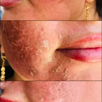 پاکسازی و فیشال های تخصصی و درمانی خانم هاوآقایان