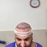 کاشت مو تضمینی