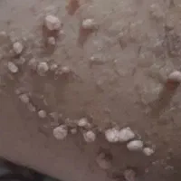 اچ اس وی درمان در 30روز