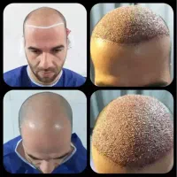 جشنواره ویژه کاشت تخصصی موشیرازی ۸میلیون باضمانت