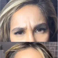 جشنواره تخفیقات تزریق ژل ، بوتاکس،جوانساز، لیزر