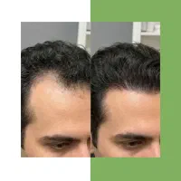 رویش مو تضمینی