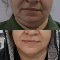 هایفوتراپی و لیفت طبیعی پوست
