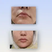 تزریق فیلر وبوتاکس تخصصی