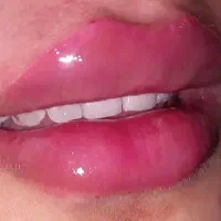 خدمات ژل و بوتاکس با مدرک تخصصی