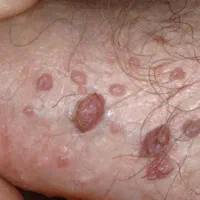 کلینیک درمان زگیل تناسلی و تبخال ایران HPV