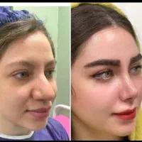 جراحی بینی با تخفیف ویژه (فقط تا پایان شهریور ماه)