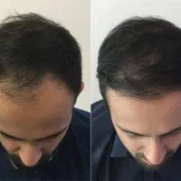 بدون کاشت موهاتو‌ برگردون
