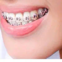 مشاوره ارتودنسی توسط متخصص