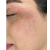 لیزر لک وکک ومک وروشن سازی پوست وخال برداری تضمینی