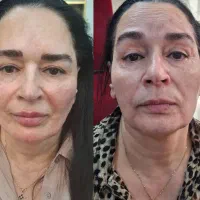 فیلر ۸۰۰پروفایلو فقط ۹ بوتاکس فول فیس ۸۰۰