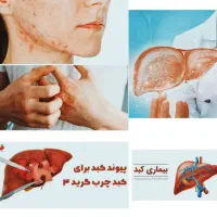 درمان کبد چرب ( گرید ۱ تا ۳ )