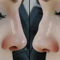 تزریق ژل و بوتاکس