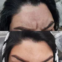 بوتاکس شب یلدا