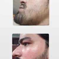 احیای طبیعی فولیکول‌ها