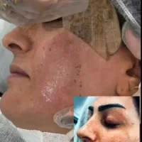 فیشیال و پاکسازی پوست ودرمان لک با متد اسپاتارک