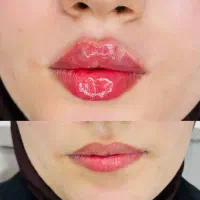 ژل بوتاکس فیلر مزو prp و prf اگزوزوم تراپی باتخفیف