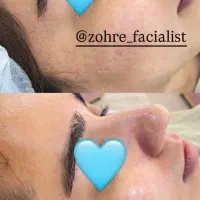 فیشال تخصصی پاکسازی پوست تخفیف ویژه کربوکسی تراپی