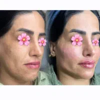 خدمات تخصصی فیلرژل بوتاکس فیلربادی فیشیال پی ارپی