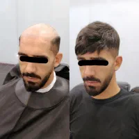 پروتز مو طبیعی رفع طاسی سر بدون درد و نقاهت